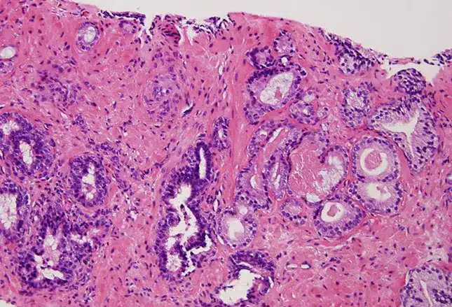 Perfeccionando el diagnóstico de cáncer de próstata: el ganglio centinela. Más precisión y menos riesgos